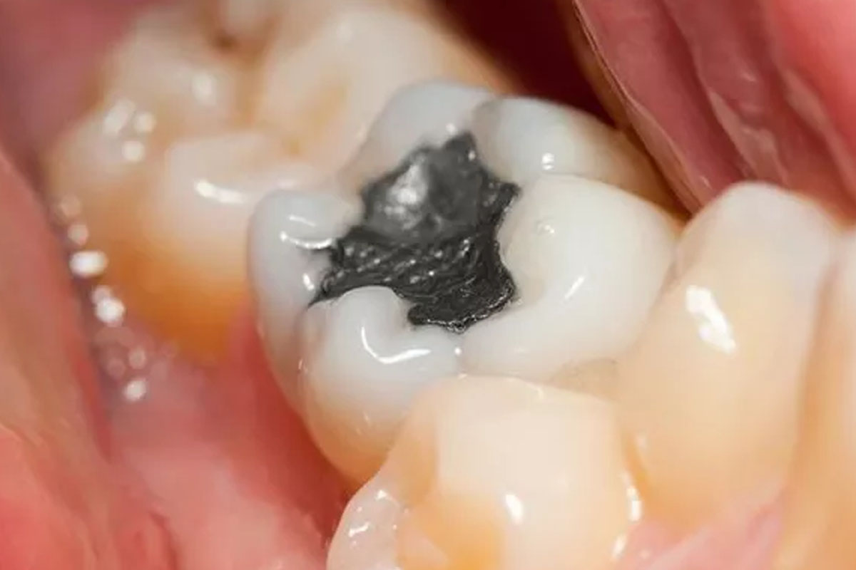 Amalgam entfernen Hannover ist Bestandteil Biologischer Zahnmedizin
