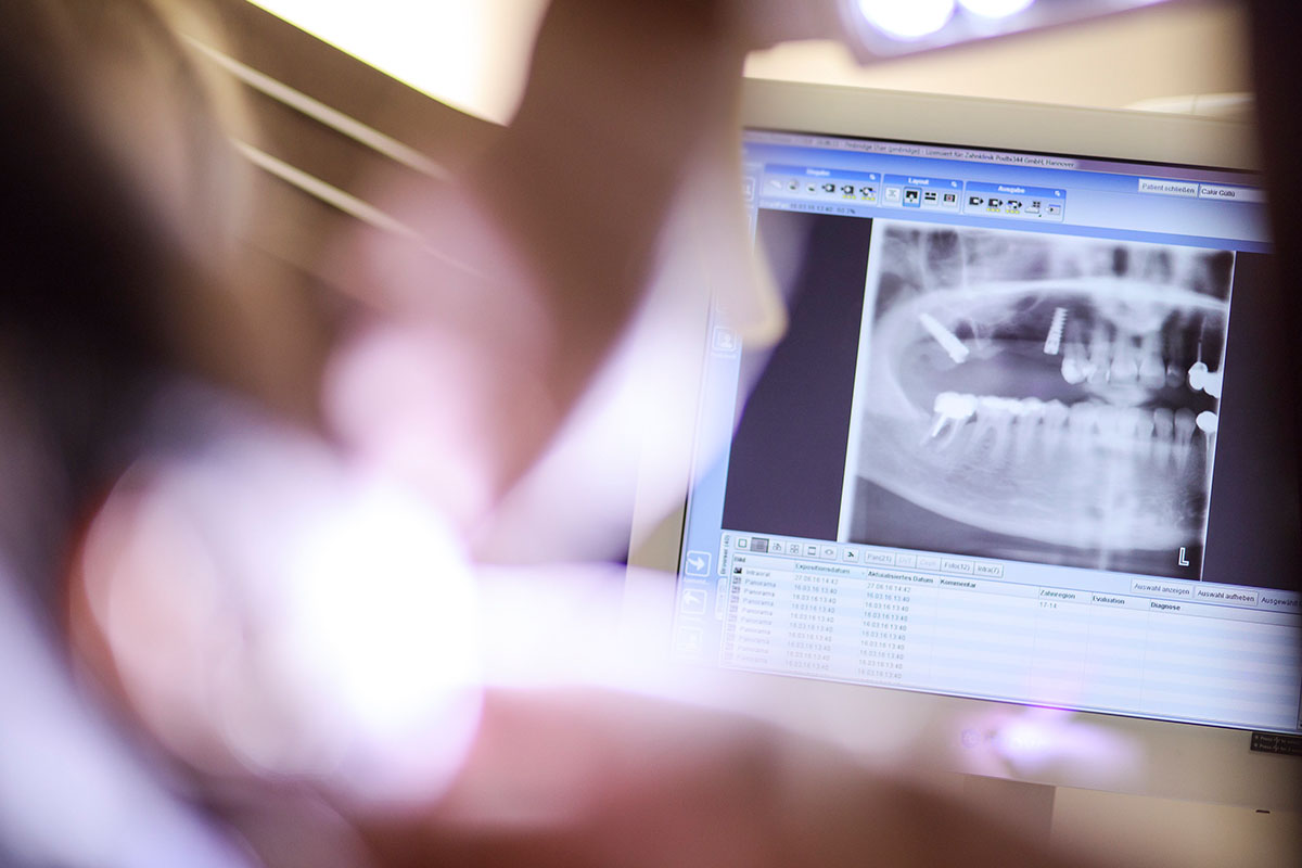 Röntgenbild bei Zahnimplantation für Kieferknochenaufbau Hannover