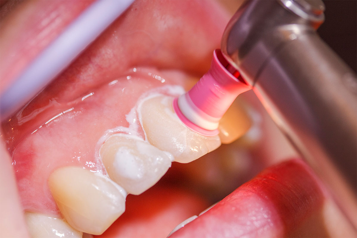 Polieren ist Bestandteil der Professionellen Zahnreinigung Hannover bei PODBI344