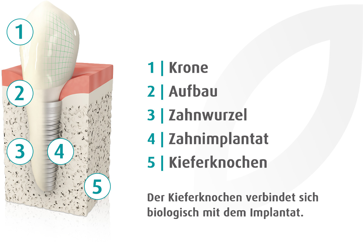 Zahnimplantat in Hannover: Aufbau von Krone, Aufbau, Zahnwurzel, Implantat und Kieferknochen in der Zahnarztpraxis Podbi344.